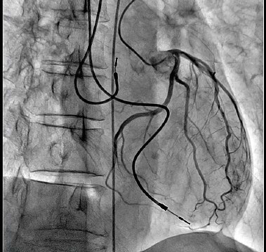搭载SCORE PRO Advance的新Trinias系列拍摄的左冠状动脉造影图像