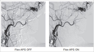 脑血管内治疗用实时自动像素偏移;Flex-APS（Flexible Active Pixel Shift）